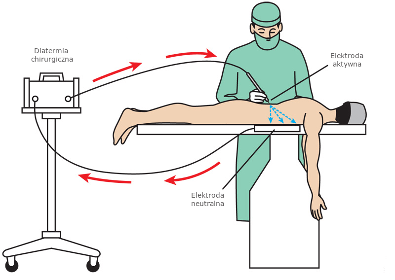 Elektrochirurgia zasada działania diatermii